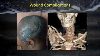 Wound Complications
 
