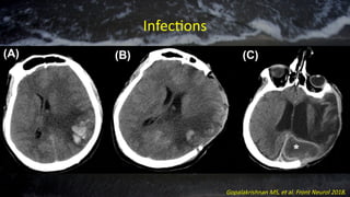 Infections
Gopalakrishnan MS, et al. Front Neurol 2018.
 