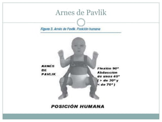 Arnes de Pavlik
 