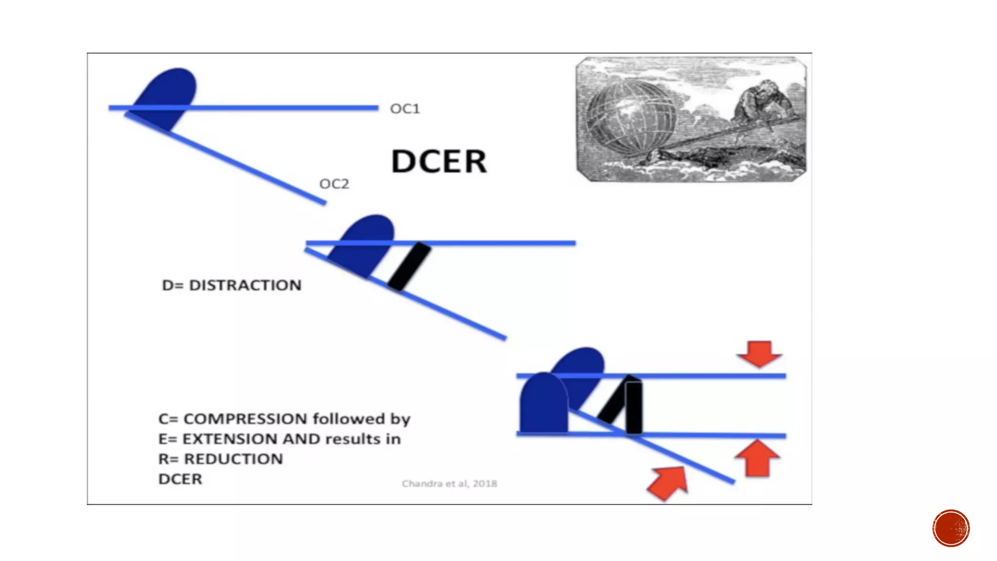 DCER (distraction, compression, extension, and reduction) technique | PDF