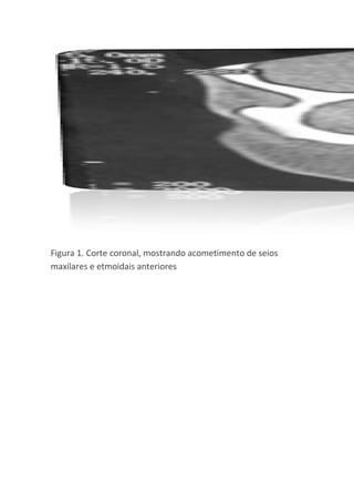 Figura 1. Corte coronal, mostrando acometimento de seios
maxilares e etmoidais anteriores
 