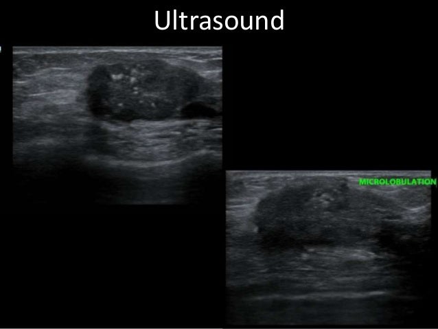 dcis ultrasound