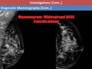 Ductal Carcinoma In Situ (DCIS) | PPTX