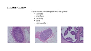 Ductal carcinoma in situ breast- management and pathology | PPTX