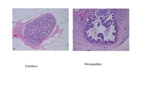 Ductal carcinoma in situ of breast - classification and management | PPTX