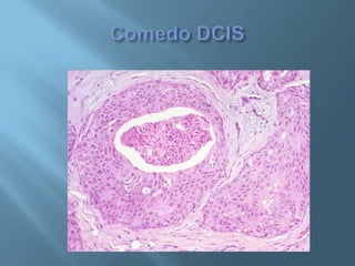 Ductal carcinoma in situ | PPTX