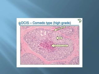 Ductal carcinoma in situ | PPTX