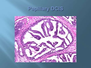 Ductal carcinoma in situ | PPTX