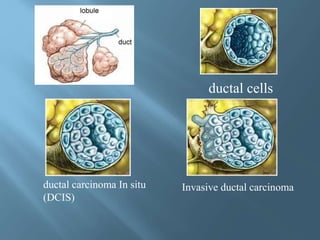 Ductal carcinoma in situ | PPTX