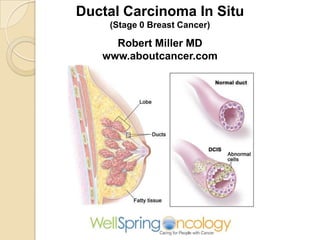Ductal Carcinoma In Situ
(Stage 0 Breast Cancer)

Robert Miller MD
www.aboutcancer.com

 