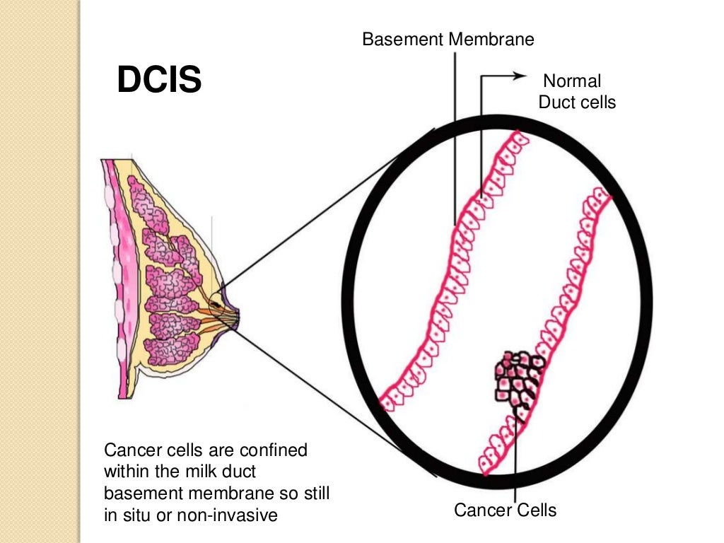 Dcis breast cancer