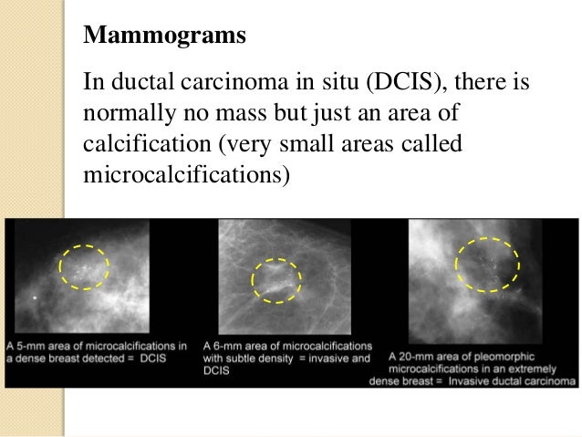 Dcis Breast Cancer