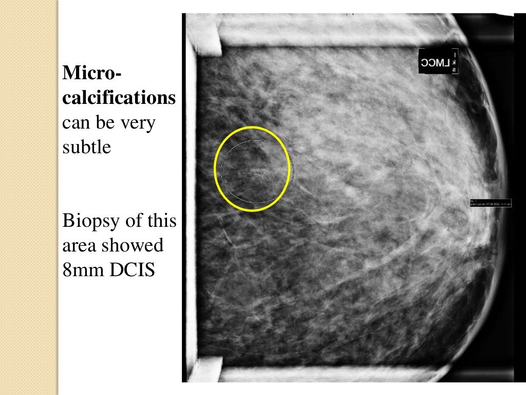 Dcis Breast Cancer