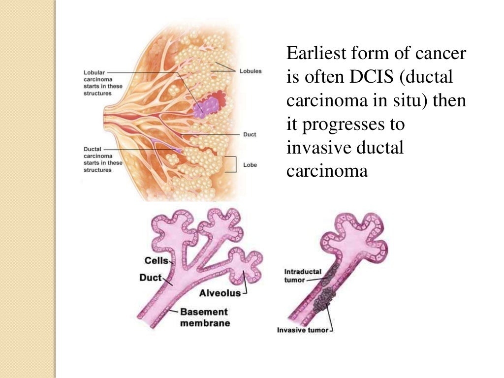 Dcis breast cancer