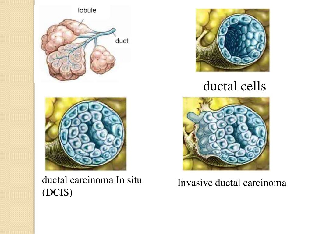 DCIS Breast Cancer dcis-breast-cancer