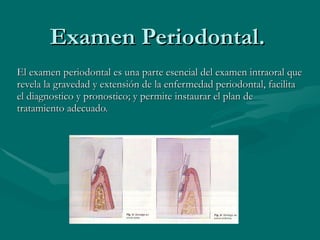 Examen Periodontal. El examen periodontal es una parte esencial del examen intraoral que revela la gravedad y extensión de la enfermedad periodontal, facilita el diagnostico y pronostico; y permite instaurar el plan de tratamiento adecuado. 