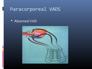 Paracorporeal VADS

 Abiomed VAD
 