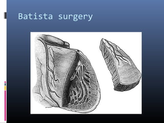 Batista surgery
 