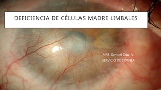 DEFICIENCIA DE CÉLULAS MADRE LIMBALES
MR3. Samuel Cruz V.
SERVICIO DE CÓRNEA
 