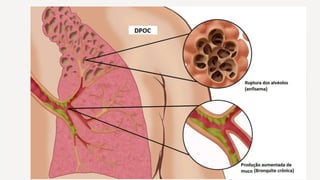 DCNT - DOENÇAS CRÔNICAS NÃO TRANSMISSIVEIS.pptx
