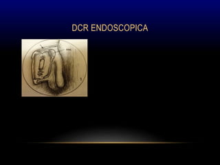 DCR ENDOSCOPICA