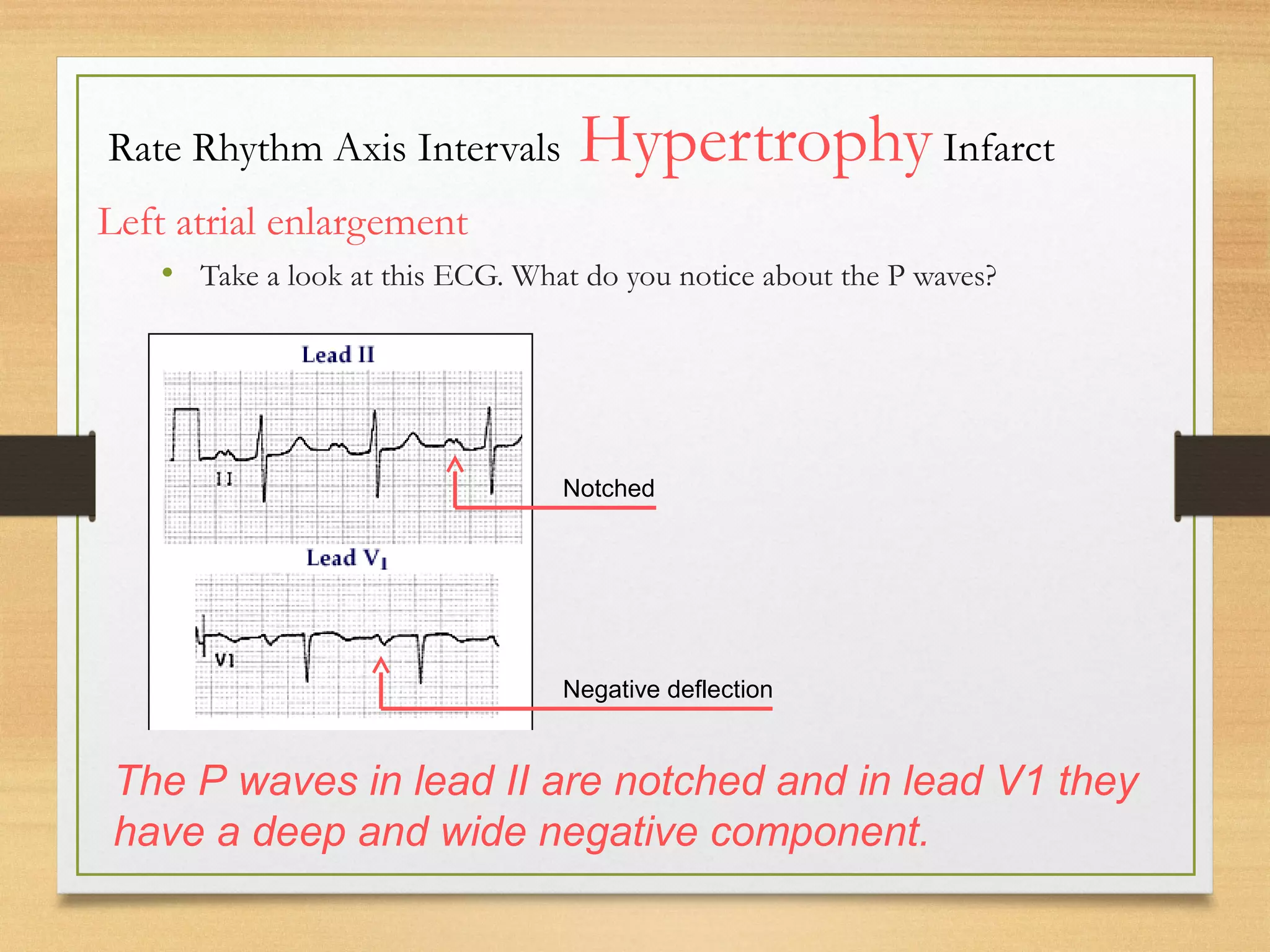 Electro Cardio Gram - Basics of ECG | PPT