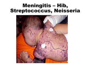 Meningitis – Hib,
Streptococcus, Neisseria
 