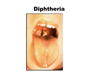 Diphtheria
 