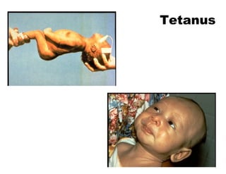 Tetanus
 