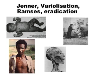 Jenner, Variolisation,
Ramses, eradication
 