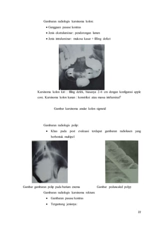 22 
Gambaran radiologis karsinoma kolon: 
 Gangguan pasase kontras 
 Jenis ekstraluminar: pendorongan lumen 
 Jenis intraluminar: mukosa kasar + filling defect 
Karsinoma kolon kiri : filling defek, biasanya 2-6 cm dengan konfigurasi apple 
core. Karsinoma kolon kanan : konstriksi atau massa intrluminal5 
Gambar karsinoma anular kolon sigmoid 
Gambaran radiologis polip: 
 Khas pada post evakuasi terdapat gambaran radiolusen yang 
berbentuk multipel 
Gambar gambaran polip pada barium enema Gambar peduncaled polyp 
Gambaran radiologis karsinoma rektum: 
 Gambaran pasase kontras 
 Tergantung jenisnya: 
 