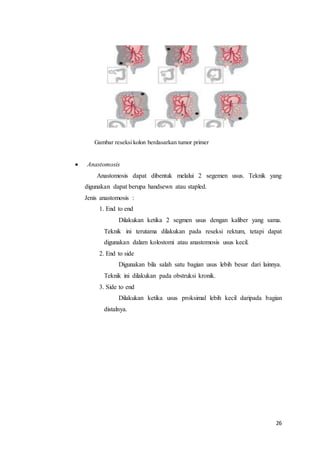 26 
Gambar reseksi kolon berdasarkan tumor primer 
 Anastomosis 
Anastomosis dapat dibentuk melalui 2 segemen usus. Teknik yang 
digunakan dapat berupa handsewn atau stapled. 
Jenis anastomosis : 
1. End to end 
Dilakukan ketika 2 segmen usus dengan kaliber yang sama. 
Teknik ini terutama dilakukan pada reseksi rektum, tetapi dapat 
digunakan dalam kolostomi atau anastomosis usus kecil. 
2. End to side 
Digunakan bila salah satu bagian usus lebih besar dari lainnya. 
Teknik ini dilakukan pada obstruksi kronik. 
3. Side to end 
Dilakukan ketika usus proksimal lebih kecil daripada bagian 
distalnya. 
 