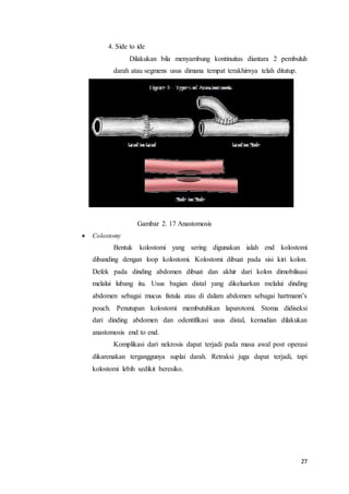 27 
4. Side to ide 
Dilakukan bila menyambung kontinuitas diantara 2 pembuluh 
darah atau segmens usus dimana tempat terakhirnya telah ditutup. 
End to end End to side 
Side to side 
Gambar 2. 17 Anastomosis 
 Colostomy 
Bentuk kolostomi yang sering digunakan ialah end kolostomi 
dibanding dengan loop kolostomi. Kolostomi dibuat pada sisi kiri kolon. 
Defek pada dinding abdomen dibuat dan akhir dari kolon dimobilisasi 
melalui lubang itu. Usus bagian distal yang dikeluarkan melalui dinding 
abdomen sebagai mucus fistula atau di dalam abdomen sebagai hartmann’s 
pouch. Penutupan kolostomi membutuhkan laparotomi. Stoma didiseksi 
dari dinding abdomen dan odentifikasi usus distal, kemudian dilakukan 
anastomosis end to end. 
Komplikasi dari nekrosis dapat terjadi pada masa awal post operasi 
dikarenakan terganggunya suplai darah. Retraksi juga dapat terjadi, tapi 
kolostomi lebih sedikit beresiko. 
 