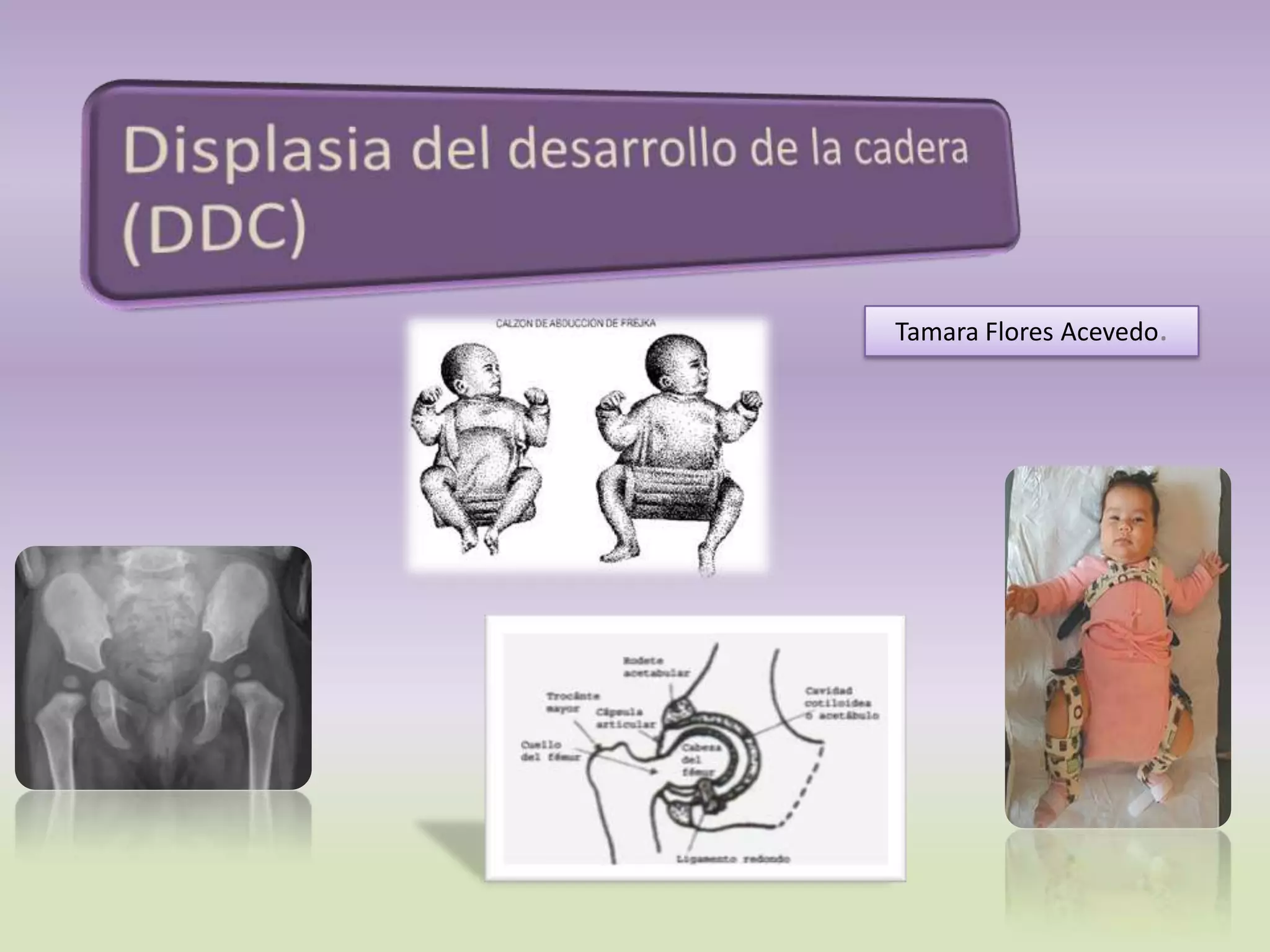Displasia del desarrollo de las caderas | PPTX