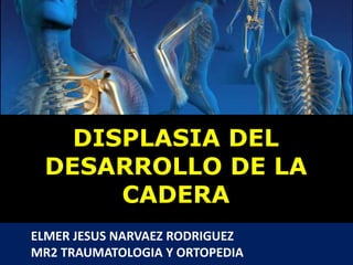 HOSPITAL II CHOCOPE
ELMER JESUS NARVAEZ RODRIGUEZ
MR2 TRAUMATOLOGIA Y ORTOPEDIA
DISPLASIA DEL
DESARROLLO DE LA
CADERA
 