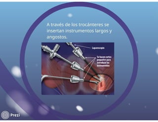 cirugia laparascopica