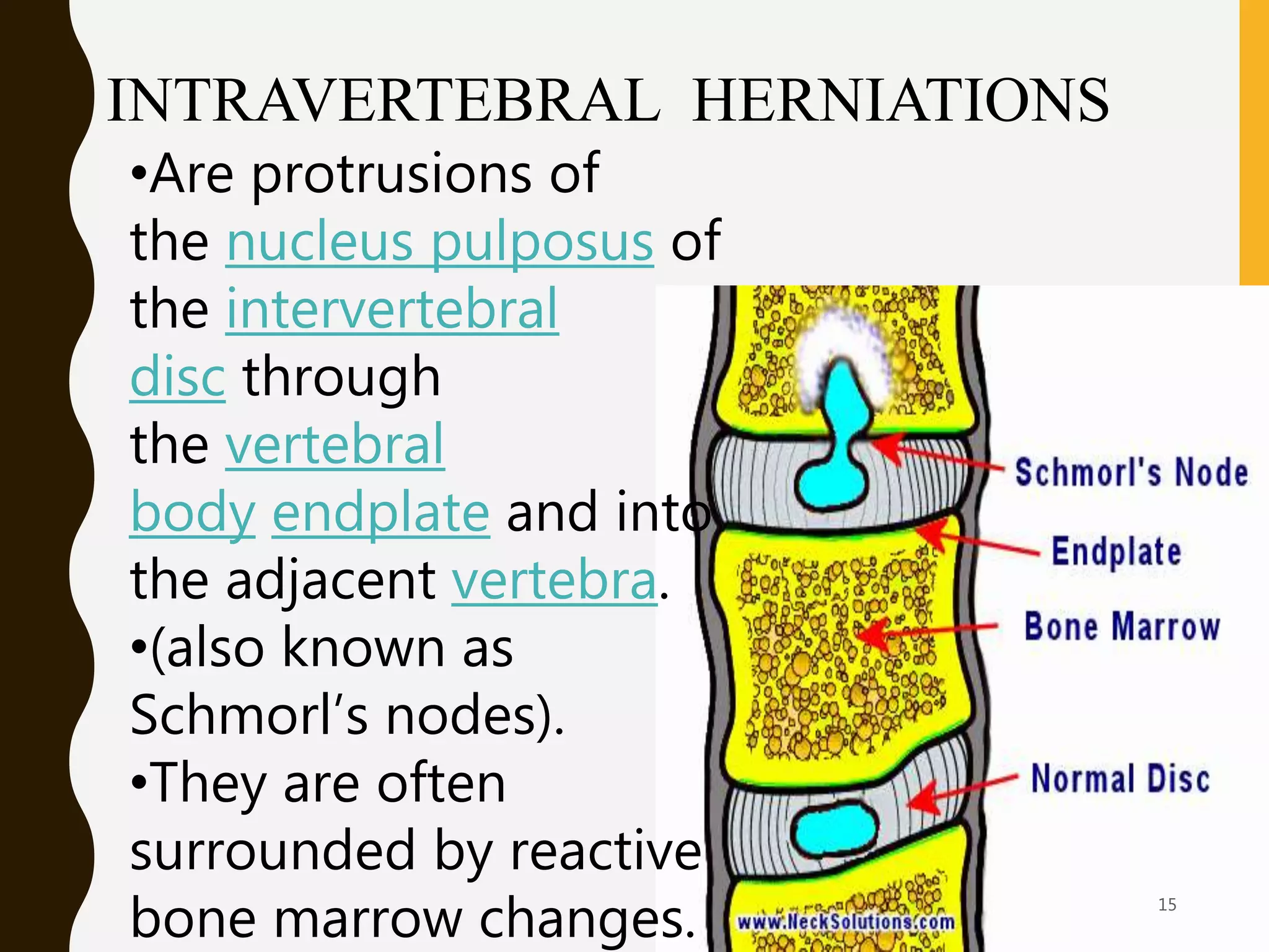 Degenerative disc disease (DDD) | PPTX