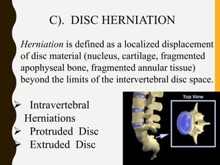 Degenerative disc disease (DDD) | PPTX