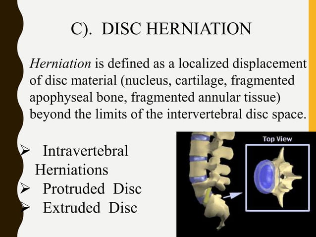 Degenerative disc disease (DDD) | PPTX | Bone and Joint Conditions ...