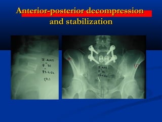 Degenerative Disc Disease - 360 Spinal Fixation | PPT