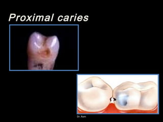 Proximal caries
Dr. Ram
 