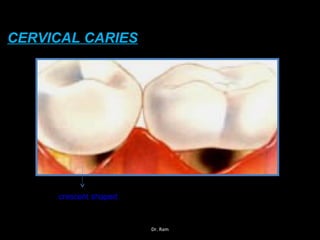CERVICAL CARIES
crescent shaped
Dr. Ram
 