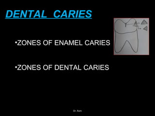 DENTAL CARIES
•ZONES OF ENAMEL CARIES
•ZONES OF DENTAL CARIES
Dr. Ram
 