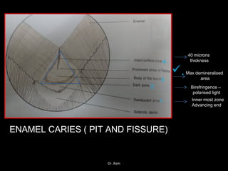 ENAMEL CARIES ( PIT AND FISSURE)
1
2
3
4
.
Inner most zone
Advancing end
Birefringence –
polarised light
Max demineralised
area
40 microns
thickness
Dr. Ram
 