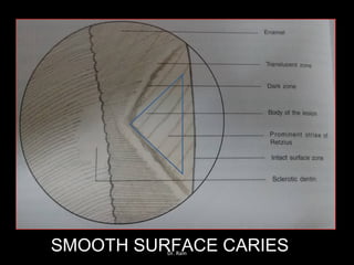 SMOOTH SURFACE CARIESDr. Ram
 