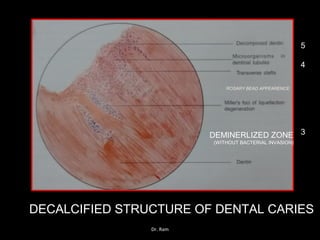 DECALCIFIED STRUCTURE OF DENTAL CARIES
5
4
3DEMINERLIZED ZONE
(WITHOUT BACTERIAL INVASION)
ROSARY BEAD APPEARENCE
Dr. Ram
 