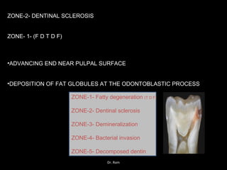ZONE-2- DENTINAL SCLEROSIS
ZONE- 1- (F D T D F)
•ADVANCING END NEAR PULPAL SURFACE
•DEPOSITION OF FAT GLOBULES AT THE ODONTOBLASTIC PROCESS
ZONE-1- Fatty degeneration (T D F)
ZONE-2- Dentinal sclerosis
ZONE-3- Demineralization
ZONE-4- Bacterial invasion
ZONE-5- Decomposed dentin
Dr. Ram
 