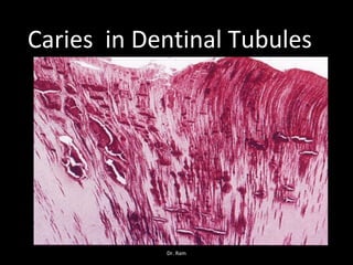Caries in Dentinal Tubules
Dr. Ram
 