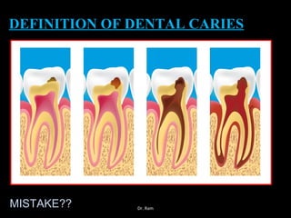 DEFINITION OF DENTAL CARIESDEFINITION OF DENTAL CARIES
MISTAKE?? Dr. Ram
 