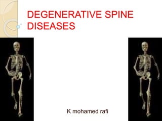 DEGENERATIVE SPINE
DISEASES
K mohamed rafi
 